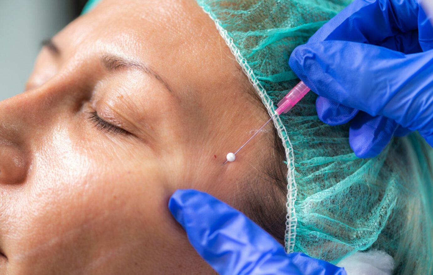 blefaroplastie-ce-este (1)